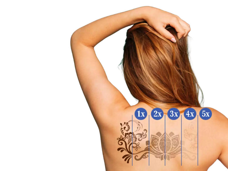 TATTOO REMOVAL