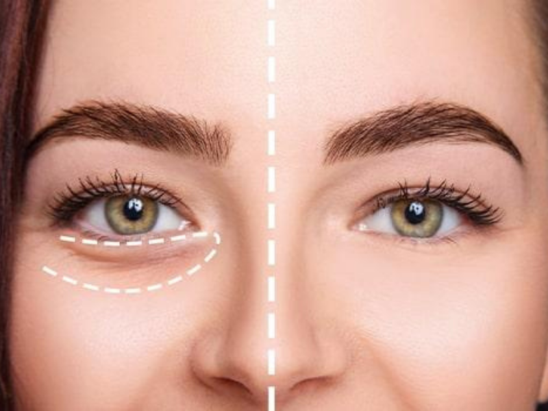 UNDER EYE LIGHT FILLER