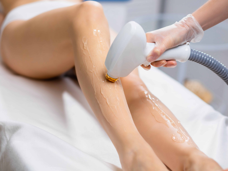 LASER EPILATION