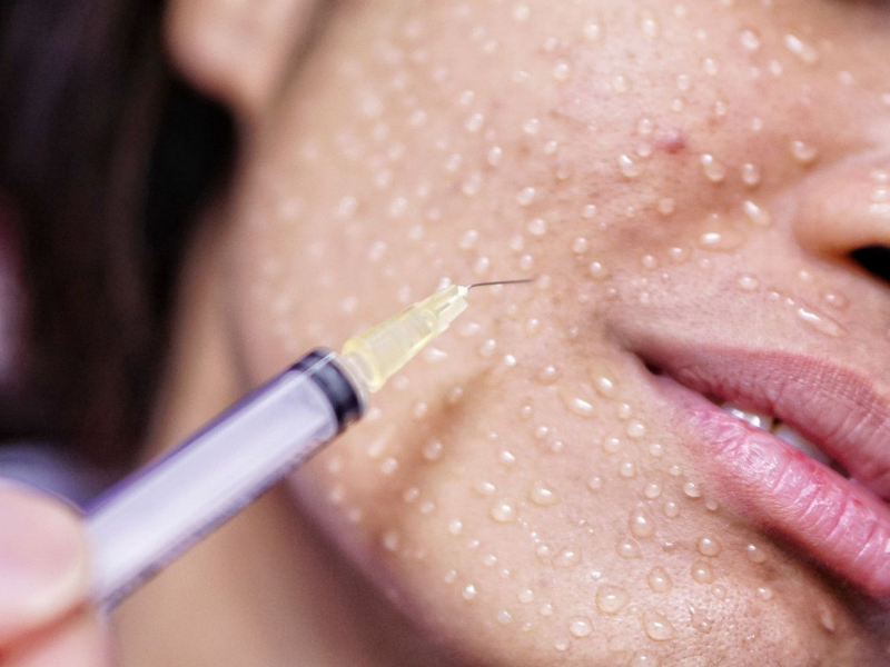 MESOTHERAPY